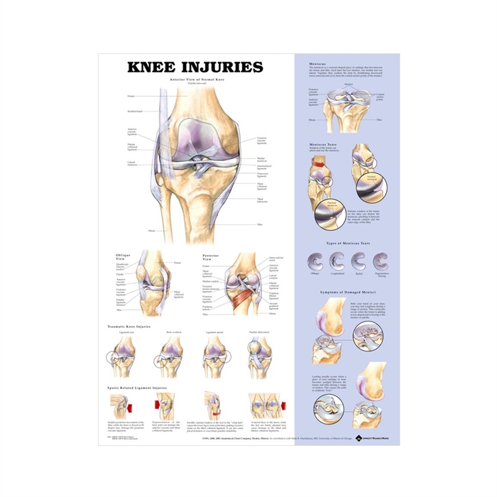 Anatomisk plakat om knæskader 51 x 66 cm